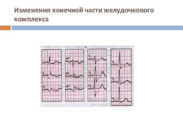 Изменения конечной части желудочкового комплекса 