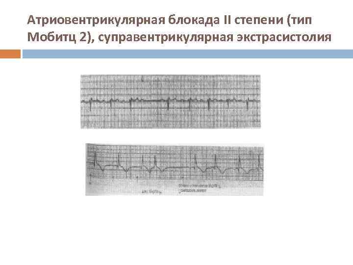 Атриовентрикулярная блокада II степени (тип Мобитц 2), суправентрикулярная экстрасистолия 