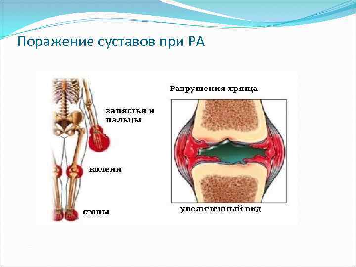 Поражение суставов при РА 