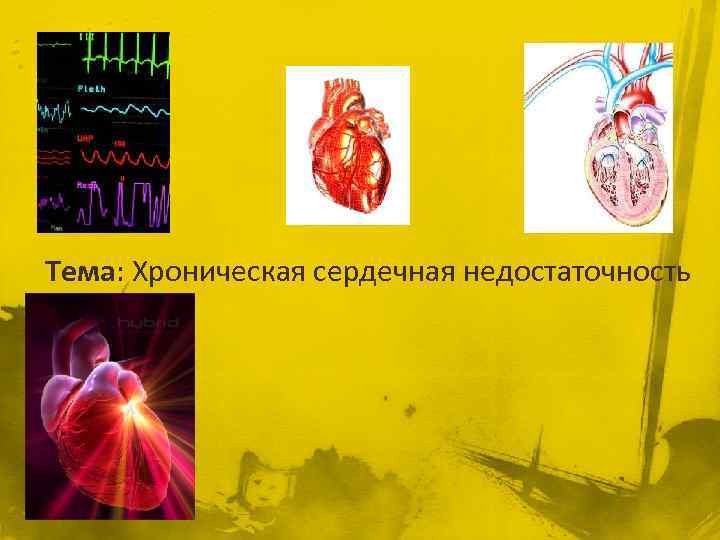 Тема: Хроническая сердечная недостаточность 