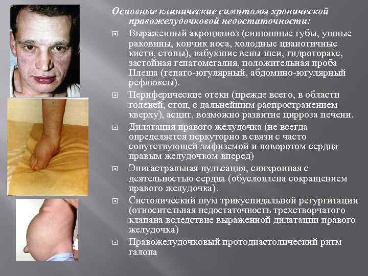 Основные клинические симптомы хронической правожелудочковой недостаточности: Выраженный акроцианоз (синюшные губы, ушные раковины, кончик носа,