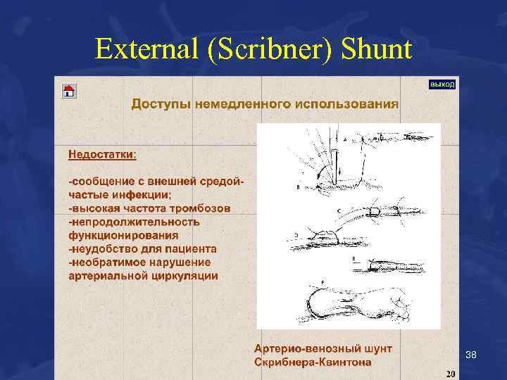 External (Scribner) Shunt 38 