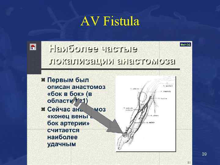 AV Fistula 39 