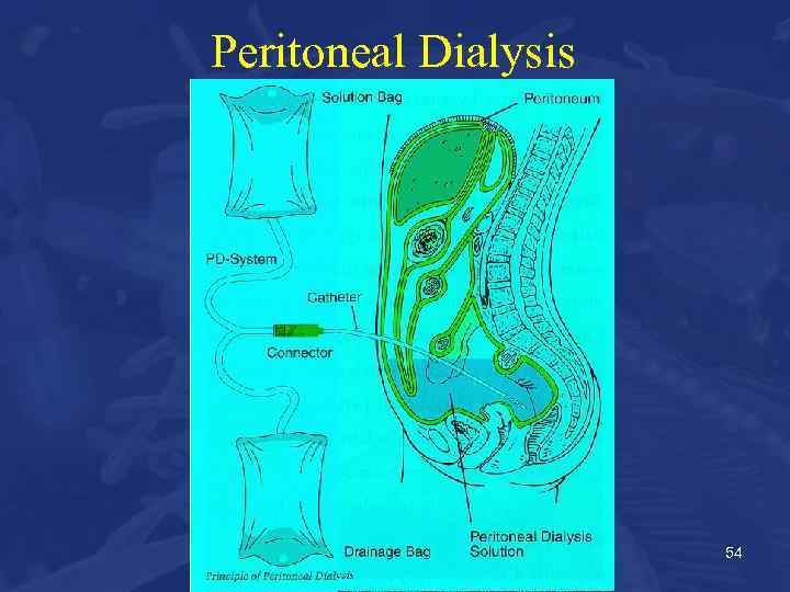 Peritoneal Dialysis 54 