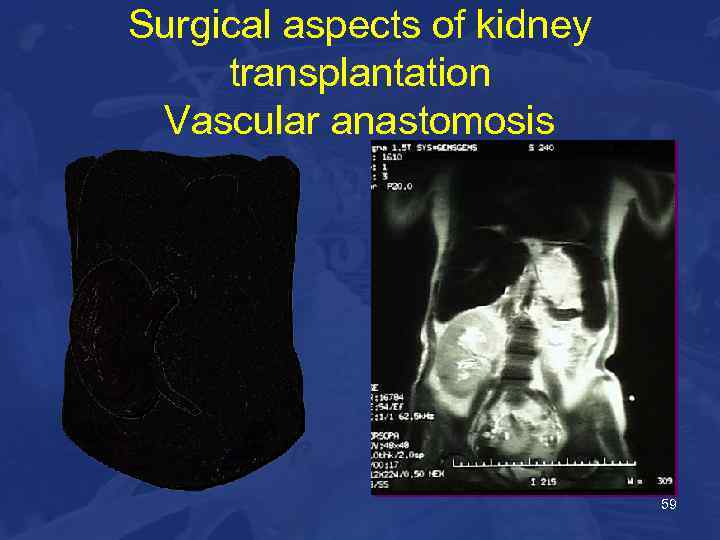 Surgical aspects of kidney transplantation Vascular anastomosis 59 