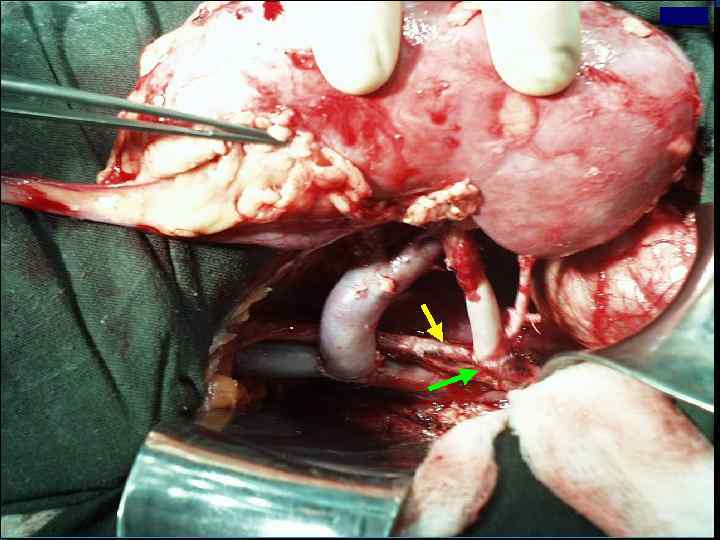 ВЫХОД Хирургические аспекты трансплантации почки детям. Сосудистые анастомозы. 60 14 