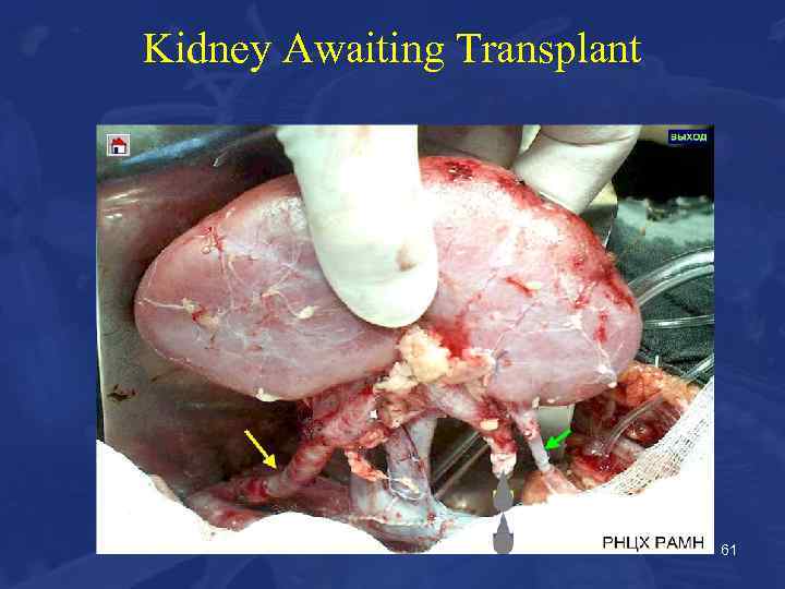 Kidney Awaiting Transplant 61 