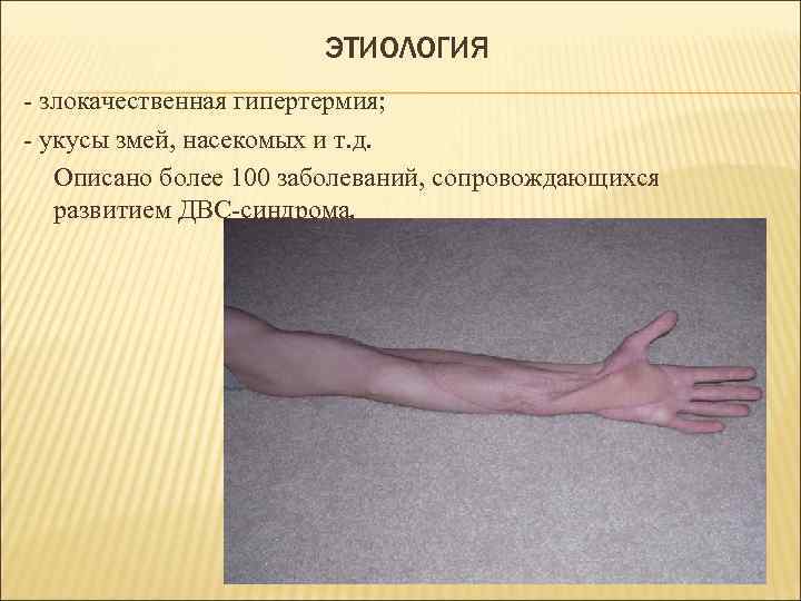 ЭТИОЛОГИЯ - злокачественная гипертермия; - укусы змей, насекомых и т. д. Описано более 100