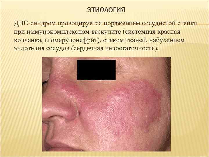 ЭТИОЛОГИЯ ДВС-синдром провоцируется поражением сосудистой стенки при иммунокомплексном васкулите (системная красная волчанка, гломерулонефрит), отеком