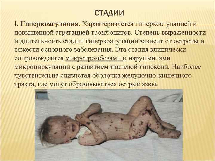СТАДИИ I. Гиперкоагуляция. Характеризуется гиперкоагуляцией и повышенной агрегацией тромбоцитов. Степень выраженности и длительность стадии