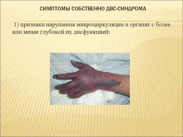СИМПТОМЫ СОБСТВЕННО ДВС-СИНДРОМА 1) признаки нарушения микроциркуляции в органах с более или менее глубокой