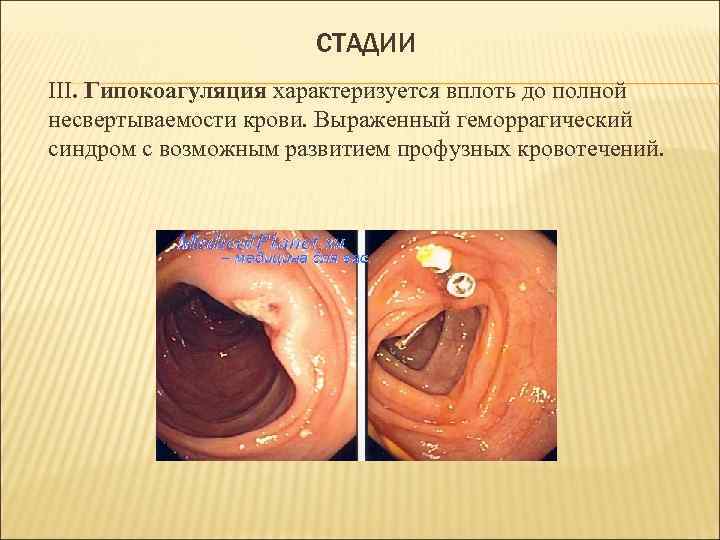 СТАДИИ III. Гипокоагуляция характеризуется вплоть до полной несвертываемости крови. Выраженный геморрагический синдром с возможным