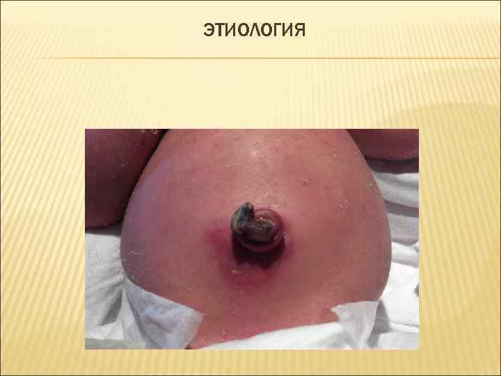 ЭТИОЛОГИЯ 