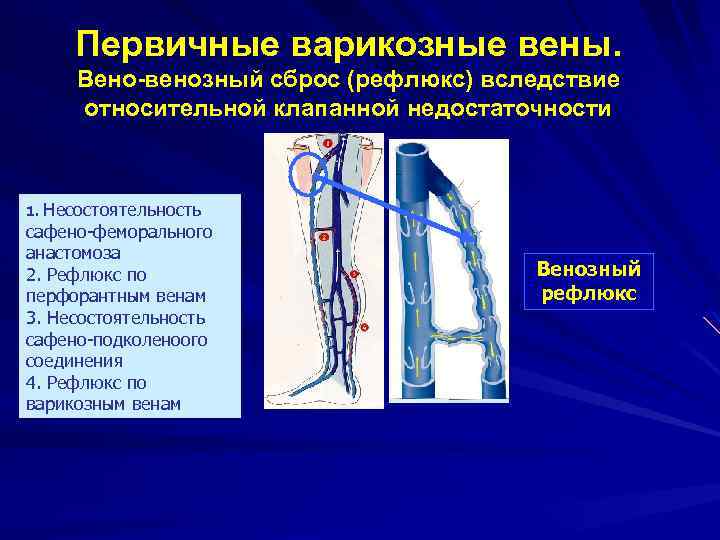 Первичные варикозные вены. Вено-венозный сброс (рефлюкс) вследствие относительной клапанной недостаточности 1. Несостоятельность сафено-феморального анастомоза