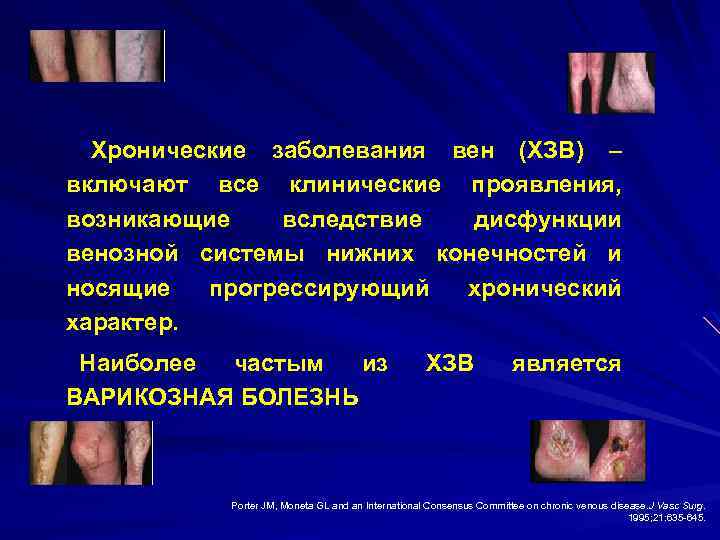 “Хронические заболевания вен (ХЗВ) – включают все клинические проявления, возникающие вследствие дисфункции венозной системы