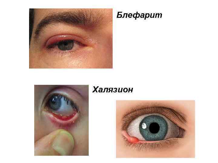 Блефарит Халязион 