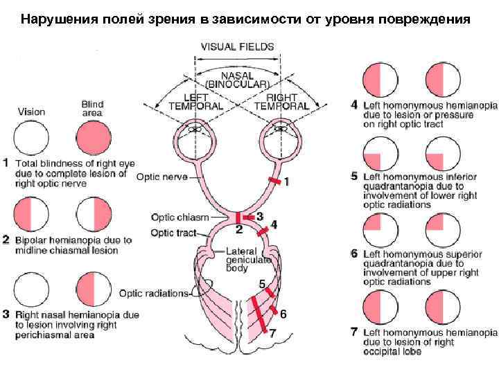 Нарушения полей зрения в зависимости от уровня повреждения 