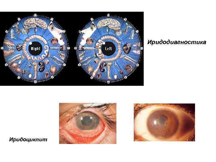 Иридодиагностика Иридоциклит 