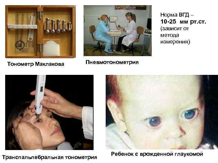 Норма ВГД – 10 -25 мм рт. ст. (зависит от метода измерения) Тонометр Маклакова