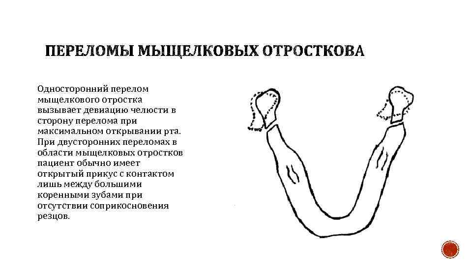 Односторонний перелом мыщелкового отростка вызывает девиацию челюсти в сторону перелома при максимальном открывании рта.