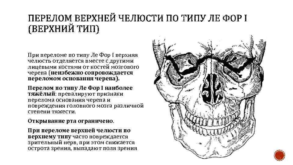 При переломе по типу Ле Фор I верхняя челюсть отделяется вместе с другими лицевыми