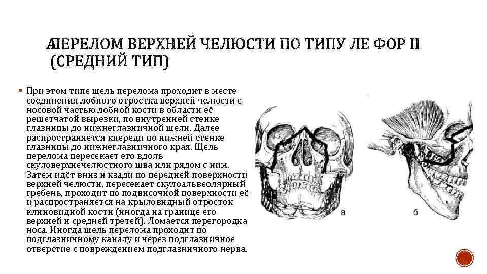 § При этом типе щель перелома проходит в месте соединения лобного отростка верхней челюсти