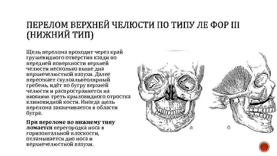 Щель перелома проходит через край грушевидного отверстия кзади по передней поверхности верхней челюсти несколько