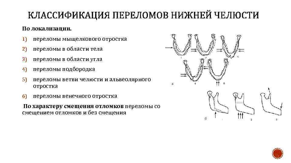 По локализации. 1) переломы мыщелкового отростка 2) переломы в области тела 3) переломы в