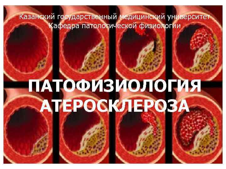 Казанский государственный медицинский университет Кафедра патологической физиологии ПАТОФИЗИОЛОГИЯ АТЕРОСКЛЕРОЗА 