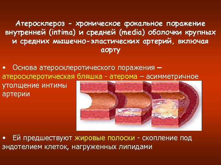 Атеросклероз - хроническое фокальное поражение внутренней (intima) и средней (media) оболочки крупных и средних