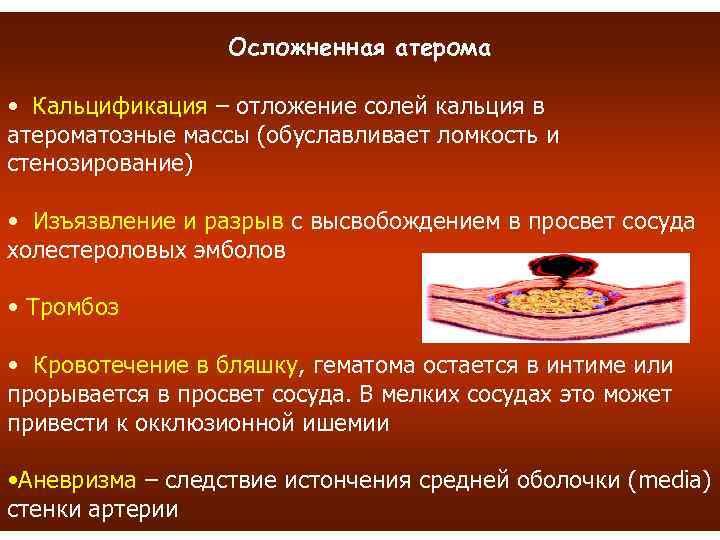 Осложненная атерома • Кальцификация – отложение солей кальция в атероматозные массы (обуславливает ломкость и