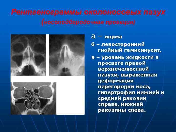 Рентгенограммы околоносовых пазух (носоподбородочная проекция) а– норма б – левосторонний гнойный гемисинусит, в –