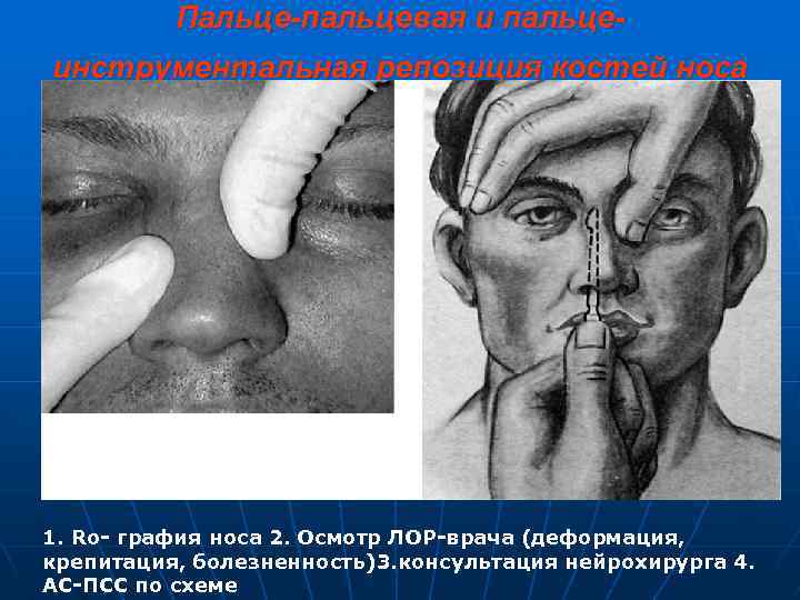 Пальце-пальцевая и пальцеинструментальная репозиция костей носа 1. Ro- графия носа 2. Осмотр ЛОР-врача (деформация,
