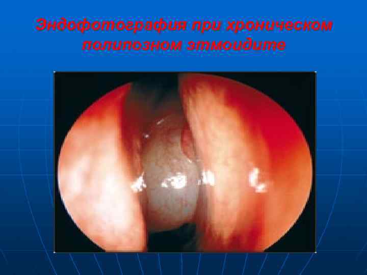 Эндофотография при хроническом полипозном этмоидите 
