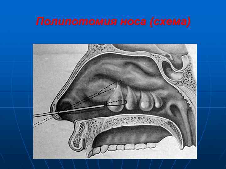 Полипотомия носа (схема) 