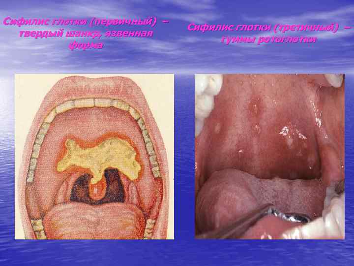 Сифилис глотки (первичный) – твердый шанкр, язвенная форма Сифилис глотки (третичный) – гуммы ротоглотки
