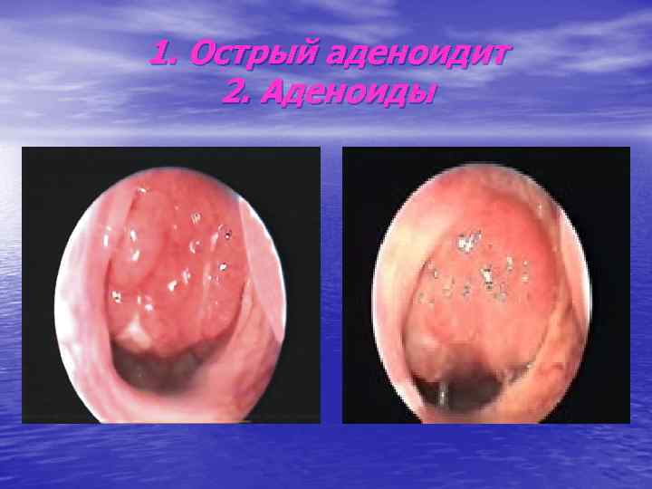 1. Острый аденоидит 2. Аденоиды 
