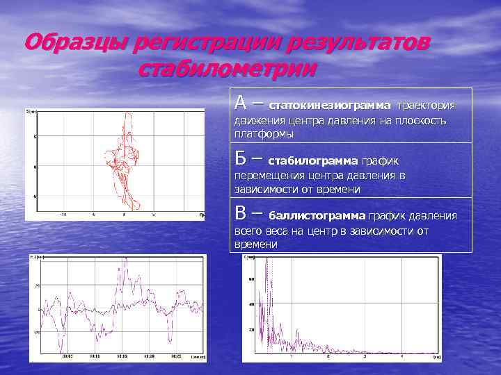 Образцы регистрации результатов стабилометрии А – статокинезиограмма траектория движения центра давления на плоскость платформы