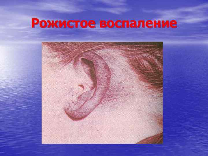 Рожистое воспаление 