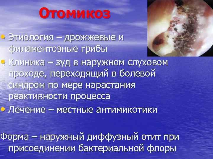 Отомикоз • Этиология – дрожжевые и филаментозные грибы • Клиника – зуд в наружном