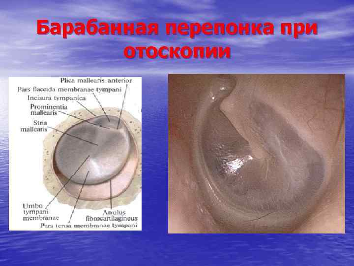 Барабанная перепонка при отоскопии 