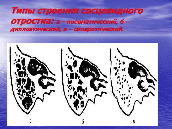 Типы строения сосцевидного отростка: а – пневматический, б – диплоэтический, в – склеротический. 