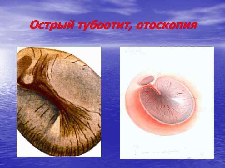 Острый тубоотит, отоскопия 