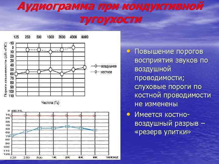 Аудиограмма при кондуктивной тугоухости • Повышение порогов • восприятия звуков по воздушной проводимости; слуховые