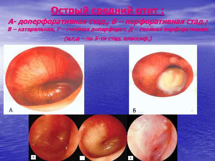 Острый средний отит : А- доперфоративная стад. , Б – перфоративная стад. ; В