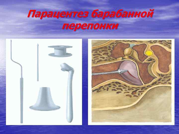 Парацентез барабанной перепонки 