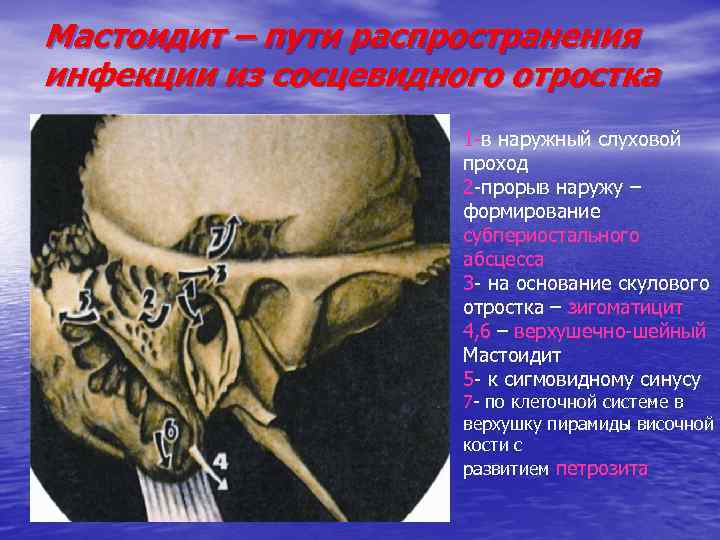 Мастоидит – пути распространения инфекции из сосцевидного отростка 1 -в наружный слуховой проход 2