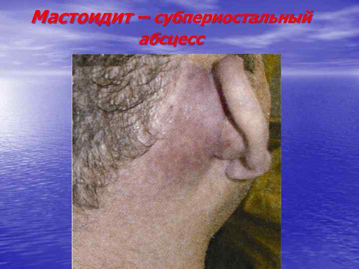 Мастоидит – субпериостальный абсцесс 