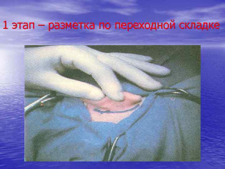 1 этап – разметка по переходной складке 