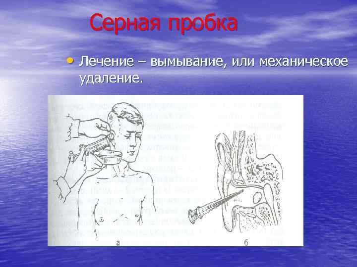 Серная пробка • Лечение – вымывание, или механическое удаление. 